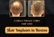 Achieve-Thicker-Fuller-Hair-with-Hair-Implants-in-Boston