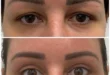 Eye Bag Removal