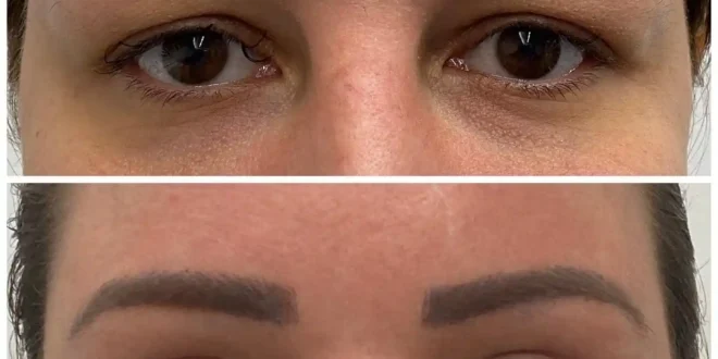 Eye Bag Removal