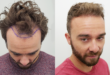 Hear from Others: Reviews of FUE Hair Transplant in London