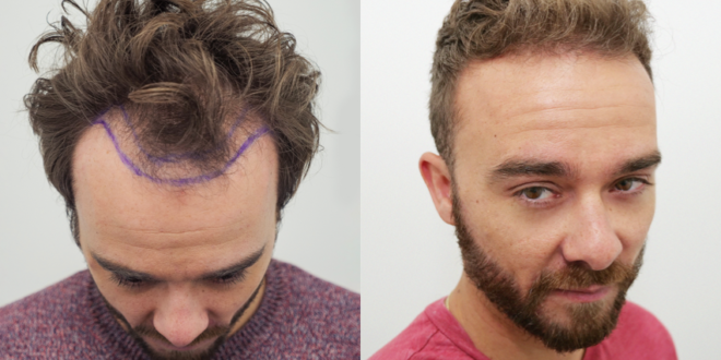 Hear from Others: Reviews of FUE Hair Transplant in London