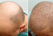 Hair Transplant Clinic in London